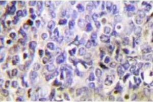 Immunohistochemistry analysis of Granzyme K in paraffin-embedded human lung carcinoma tissue. (GZMK anticorps)