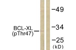 Immunohistochemistry analysis of paraffin-embedded human lung carcinoma tissue using BCL-XL (Phospho-Thr47) antibody. (BCL2L1 anticorps  (pThr47))