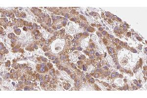 ABIN6279547 at 1/100 staining Human liver cancer tissue by IHC-P. (SLC16A6 anticorps)