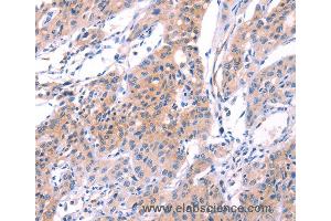 Immunohistochemistry of Human gastic cancer using VWF Polyclonal Antibody at dilution of 1:50 (VWF anticorps)