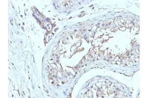 Formalin-fixed, paraffin-embedded human Testicular Ca stained with CD63 Monoclonal Antibody (NKI/C3 + LAMP3/968) (CD63 anticorps)