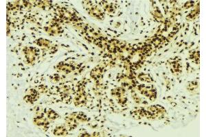 ABIN6277629 at 1/100 staining Human breast cancer tissue by IHC-P. (PRDM14 anticorps  (N-Term))