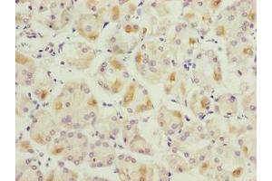 Immunohistochemistry of paraffin-embedded human gastric cancer using ABIN7158732 at dilution of 1:100 (LYSMD1 anticorps  (AA 1-227))