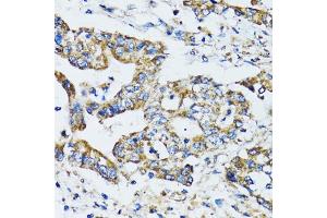 Immunohistochemistry of paraffin-embedded human colon carcinoma using ATG7 antibody (ABIN6292614) at dilution of 1:100 (40x lens). (ATG7 anticorps)