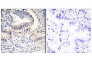 Immunohistochemical analysis of paraffin-embedded human lung carcinoma tissue using Lamin A (Cleaved-Asp230) Antibody (ABIN5978456). (Lamin A/C anticorps  (Cleaved-Asp230, Internal Region))