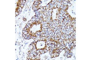 Immunohistochemistry of paraffin-embedded human Colon cancer using C2 Rabbit pAb (ABIN7265549) at dilution of 1:100 (40x lens). (AKR1C2 anticorps  (AA 1-323))