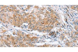 Immunohistochemistry of paraffin-embedded Human gastric cancer using CRELD2 Polyclonal Antibody at dilution of 1:50 (CRELD2 anticorps)