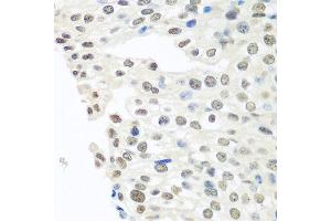Immunohistochemistry of paraffin-embedded human prostate cancer using TARDBP antibody at dilution of 1:100 (40x lens). (TARDBP anticorps)