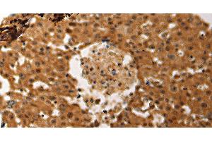 Immunohistochemistry of paraffin-embedded Human ovarian cancer tissue using JUND Polyclonal Antibody at dilution 1:60 (JunD anticorps)