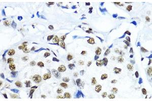 Immunohistochemistry of paraffin-embedded Human mammary cancer using TriMethyl-Histone H3-K79 Polyclonal Antibody at dilution of 1:200 (40x lens).