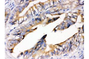 Anti- RAGE Picoband antibody, IHC(P) IHC(P): Human Intestinal Cancer Tissue