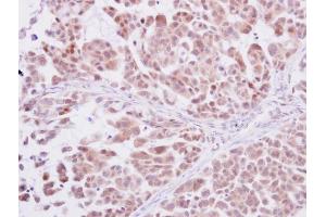 IHC-P Image DNA polymerase delta antibody detects DNA polymerase delta protein at cytoplasm and nucleus on human lung adenocarcinoma by immunohistochemical analysis.
