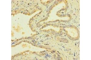 Immunohistochemistry of paraffin-embedded human prostate cancer using ABIN7166618 at dilution of 1:100
