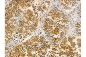 ABIN6257947 and ABIN6275876 at 1/100 staining human lung squamous cell carcinoma by IHC-P. (BTLA anticorps  (C-Term))