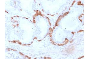 Formalin-fixed, paraffin-embedded human Prostate Carcinoma stained with Cytokeratin 14 Mouse Monoclonal Antibody (KRT14/2375).