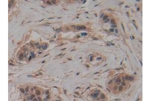 Detection of MCM5 in Human Breast cancer Tissue using Polyclonal Antibody to Minichromosome Maintenance Deficient 5 (MCM5)