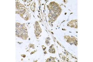 Immunohistochemistry of paraffin-embedded human gastric cancer using SBDS antibody (ABIN5973483) at dilution of 1/100 (40x lens). (SBDS anticorps)