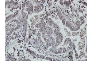 Immunoperoxidase of monoclonal antibody to FOXO3A on formalin-fixed paraffin-embedded human colon adenocarcinoma. (FOXO3 anticorps  (AA 361-460))