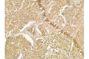 ABIN6261361 and ABIN6276770 at 1/100 staining human lung squamous cell carcinoma by IHC-P.