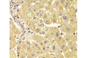 Immunohistochemistry of paraffin-embedded Human liver damage using TRAF3IP2 Polyclonal Antibody at dilution of 1:100 (40x lens). (TRAF3IP2 anticorps)