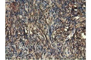 Immunohistochemical staining of paraffin-embedded Carcinoma of Human kidney tissue using anti-EPHX2 mouse monoclonal antibody. (EPHX2 anticorps)