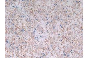 IHC-P analysis of Human Glioma Tissue, with DAB staining. (MAP2K3 anticorps  (AA 99-343))