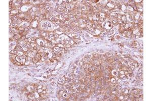 IHC-P Image Immunohistochemical analysis of paraffin-embedded human lung SCC, using ARHGAP1, antibody at 1:100 dilution. (ARHGAP1 anticorps)