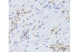 Immunohistochemistry of paraffin-embedded Human gastric cancer using GATM Polyclonal Antibody at dilution of 1:100 (40x lens).