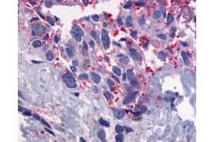 Anti-GPR56 antibody IHC of human Skin, Melanoma.