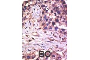 Formalin-fixed and paraffin-embedded human cancer tissue reacted with the primary antibody, which was peroxidase-conjugated to the secondary antibody, followed by AEC staining.