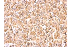IHC-P Image HSP27 antibody detects HSPB1 protein at cytosol on U87 xenograft by immunohistochemical analysis.