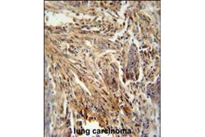 CSF2 antibody immunohistochemistry analysis in formalin fixed and paraffin embedded human lung carcinoma followed by peroxidase conjugation of the secondary antibody and DAB staining.