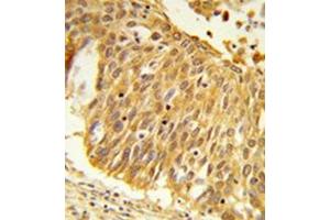 Formalin-fixed and paraffin-embedded human lung carcinoma reacted with  EEFSEC / SELB Antibody (C-term) followed which was peroxidase-conjugated to the secondary antibody, followed by DAB staining.