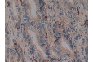 Detection of CD40 in Human Stomach cancer Tissue using Polyclonal Antibody to Tumor Necrosis Factor Receptor Superfamily, Member 5 (CD40)