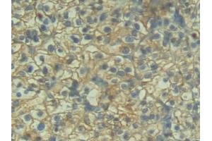 Detection of P-cadherin in Human Renal cancer Tissue using Polyclonal Antibody to Placental Cadherin (P-cadherin)