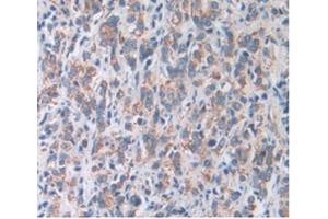 IHC-P analysis of Human Prostate Gland Cancer Tissue, with DAB staining. (SOD2 anticorps  (AA 25-222))