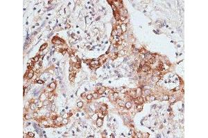 Immunohistochemistry of paraffin-embedded Human liver cancer using PIGR Polyclonal Antibody at dilution of 1:100 (40x lens). (PIGR anticorps)