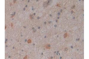 IHC-P analysis of Human Glioma Tissue, with DAB staining.