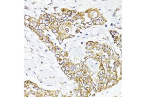 Immunohistochemistry of paraffin-embedded human colon carcinoma using MAVS antibody (ABIN6132297, ABIN6143583, ABIN6143584 and ABIN6221441) at dilution of 1:100 (40x lens). (MAVS anticorps  (AA 1-65))