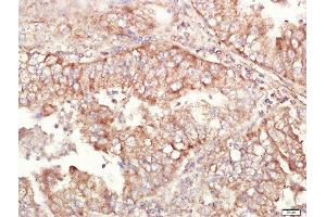Paraformaldehyde-fixed, paraffin embedded human lung carcinoma tissue, Antigen retrieval by boiling in sodium citrate buffer(pH6) for 15min, Block endogenous peroxidase by 3% hydrogen peroxide for 30 minutes, Blocking buffer (normal goat serum) at 37°C for 20min, Antibody incubation with Rabbit Anti-ALDH1 Polyclonal Antibody, Unconjugated  at 1:400 overnight at 4°C, followed by a conjugated secondary and DAB staining