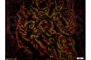 Formalin-fixed and paraffin-embedded human gastric carcinoma labeled with Anti-NRAS Polyclonal Antibody, Unconjugated (ABIN738336) 1:200, overnight at 4°C, The secondary antibody was Goat Anti-Rabbit IgG,FITC conjugated used at 1:200 dilution for 40 minutes at 37°C.