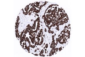Malignant mesothelioma with strong cytokeratin 19 positivity