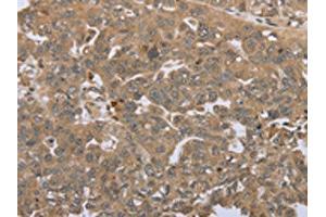 The image on the left is immunohistochemistry of paraffin-embedded Human ovarian cancer tissue using ABIN7192692(STMN2/STMN3/STMN4 Antibody) at dilution 1/45, on the right is treated with synthetic peptide. (STMN2/STMN3/STMN4 anticorps)