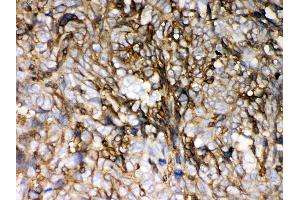 Anti- HLA-C Picoband antibody,IHC(P) IHC(P): Human Lung Cancer Tissue (HLA-C anticorps  (C-Term))