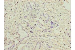 Immunohistochemistry of paraffin-embedded human pancreatic cancer using ABIN7158038 at dilution of 1:100 (LRG1 anticorps  (AA 36-346))