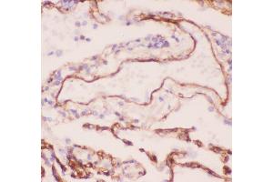 Anti-Collagen IV Picoband antibody,  IHC(P): Human Lung Cancer Tissue (COL4A1 anticorps  (AA 1445-1669))