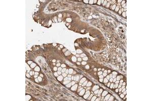 Immunohistochemical staining of human colon with ADSS polyclonal antibody  shows moderate cytoplasmic positivity in glandular cells at 1:20-1:50 dilution. (ADSS anticorps)