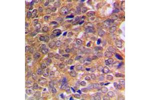 Immunohistochemical analysis of ABL1/2 (pY393/439) staining in human breast cancer formalin fixed paraffin embedded tissue section. (ABL1/2 anticorps  (C-Term, pTyr393, pTyr439))