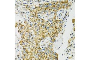Immunohistochemistry of paraffin-embedded human lung cancer using HSPA9 antibody. (HSPA9 anticorps  (AA 380-679))