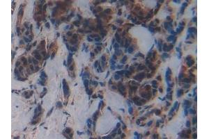 Detection of MPG in Human Breast cancer Tissue using Polyclonal Antibody to N-Methylpurine DNA Glycosylase (MPG)